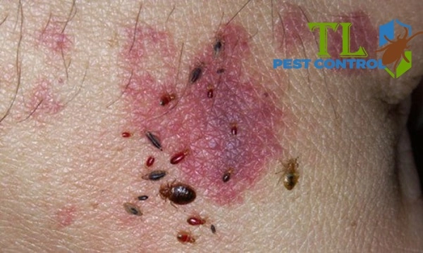 cách trị mạt giường